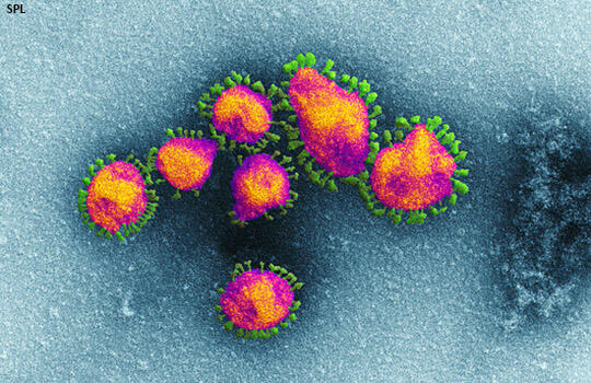 Scanning electron microscope image shows SARS-CoV-2 (yellow) also known as 2019-nCoV Scanning electron microscope image shows SARS-CoV-2 (yellow) also known as 2019-nCoV